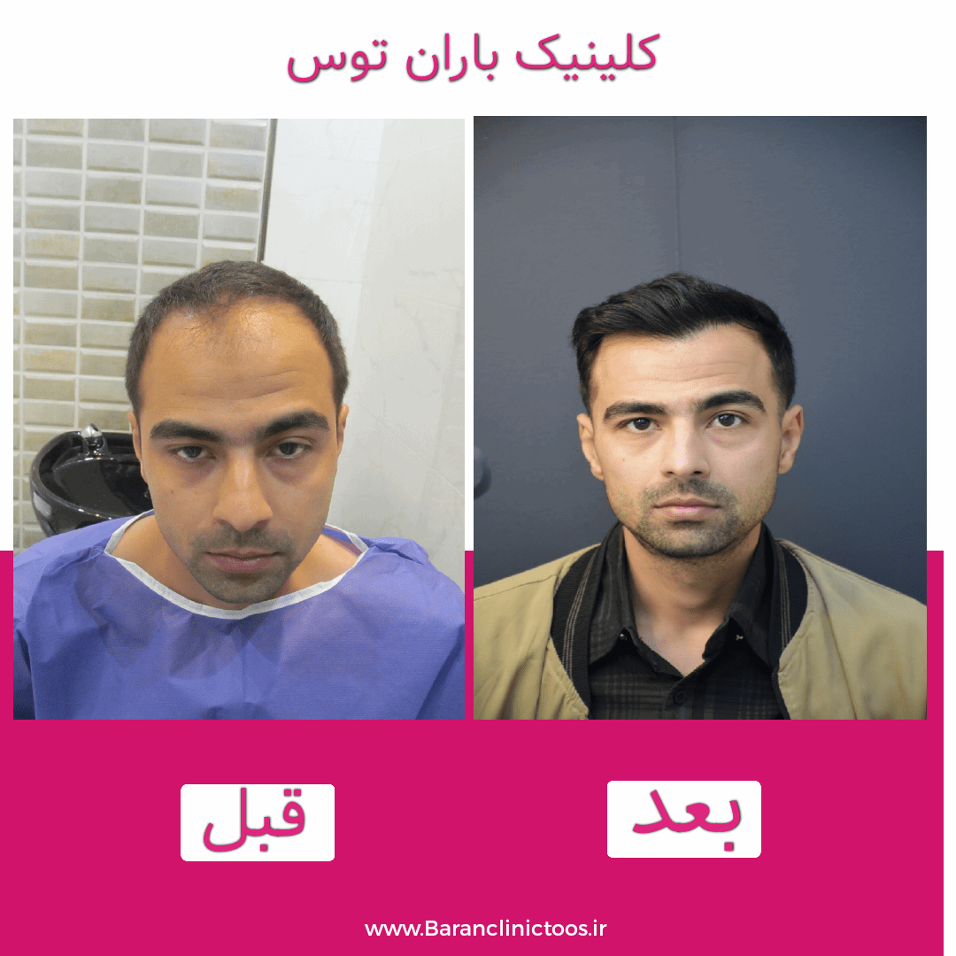 قبل و بعد کاشت مو